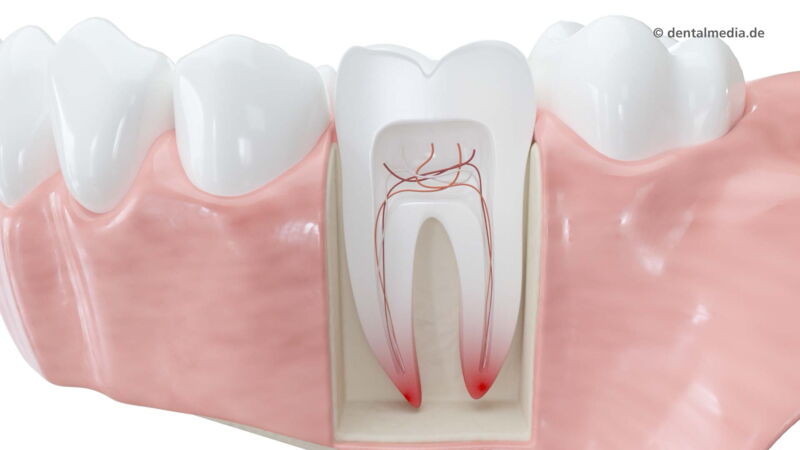 Wurzelbehandlung Zahninneres